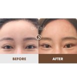 Before and after blepharoplasty results at Dr. Tak Plastic Surgery, eyelid correction outcome