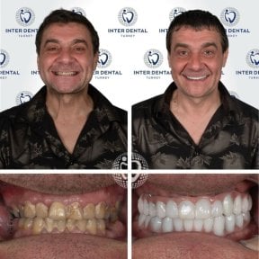 Результаты до и после установки циркониевых коронок в Inter Dental Turkey – преображение улыбки