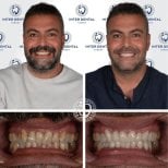 Результаты до и после установки циркониевых коронок в Inter Dental Turkey – белоснежная улыбка