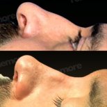 نتائج عملية تجميل الأنف قبل وبعد في مستشفى ميموريال شيشلي، تحسين شكل الأنف