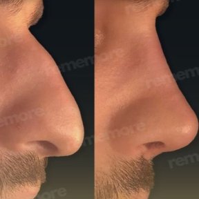نتائج تجميل الأنف قبل وبعد في مستشفى ميموريال شيشلي، تحسين شكل الأنف