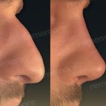 نتائج تجميل الأنف قبل وبعد في مستشفى ميموريال شيشلي، تحسين شكل الأنف