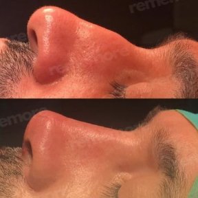نتائج تجميل الأنف قبل وبعد في مستشفى ميموريال شيشلي، تحسين شكل الأنف