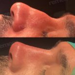 نتائج تجميل الأنف قبل وبعد في مستشفى ميموريال شيشلي، تحسين شكل الأنف