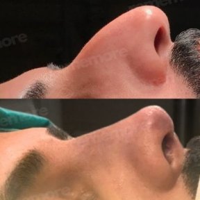 نتائج تجميل الأنف قبل وبعد في مستشفى ميموريال شيشلي، تحسين شكل الأنف