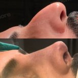 نتائج تجميل الأنف قبل وبعد في مستشفى ميموريال شيشلي، تحسين شكل الأنف