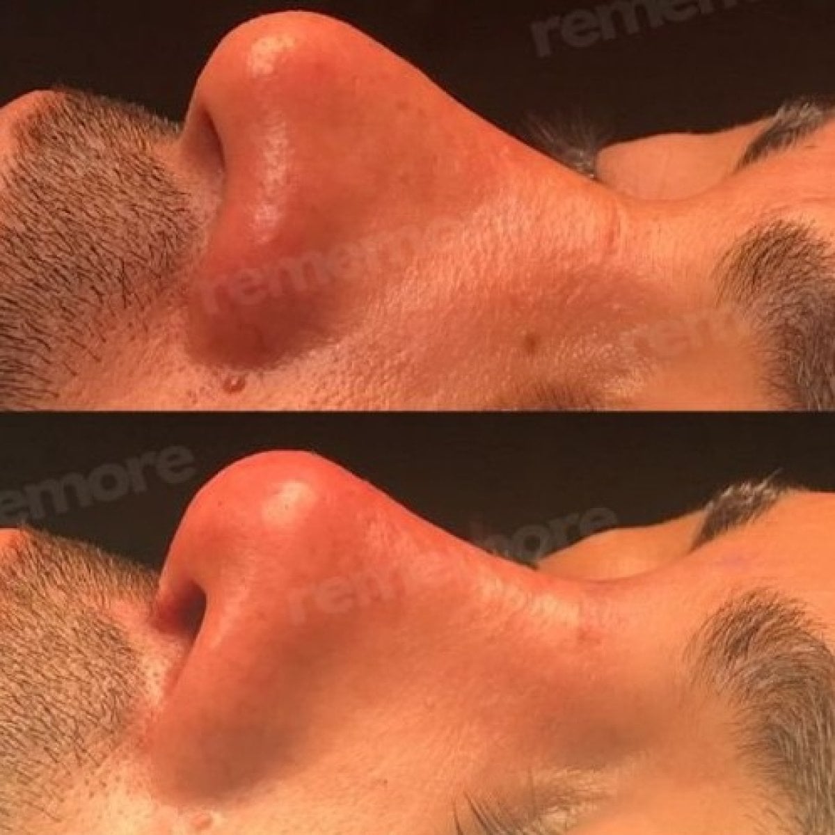 Resultado de rinoplastia antes y después en Memorial Şişli Hospital, perfil nasal mejorado