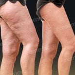 Before and after thigh lift results at Memorial Şişli Hospital, smoother and firmer thighs