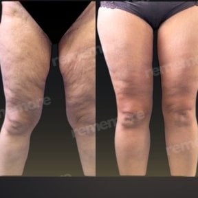 Before and after thigh lift results at Memorial Şişli Hospital, smoother and firmer thighs