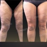 Before and after thigh lift results at Memorial Şişli Hospital, smoother and firmer thighs