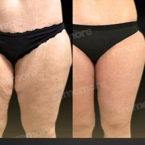Before and after thigh lift results at Memorial Şişli Hospital, improved thigh contour