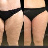 Before and after thigh lift results at Memorial Şişli Hospital, improved thigh contour