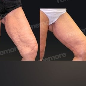 Before and after thigh lift results at Memorial Şişli Hospital, improved leg contour and skin