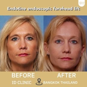 Результаты до и после эндоскопической подтяжки лба Endotine в ID Clinic Bangkok