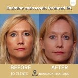 Результаты до и после эндоскопической подтяжки лба Endotine в ID Clinic Bangkok