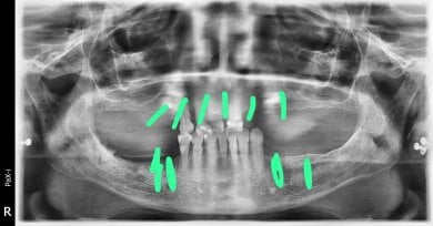 before-after photo all-on-6-dental-implants