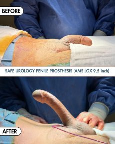 before-after photo penile-implant-surgery