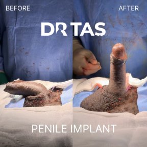 before-after photo penile-implant-surgery