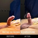 Before and after penile curvature correction for Peyronie's disease at Safe Urology clinic