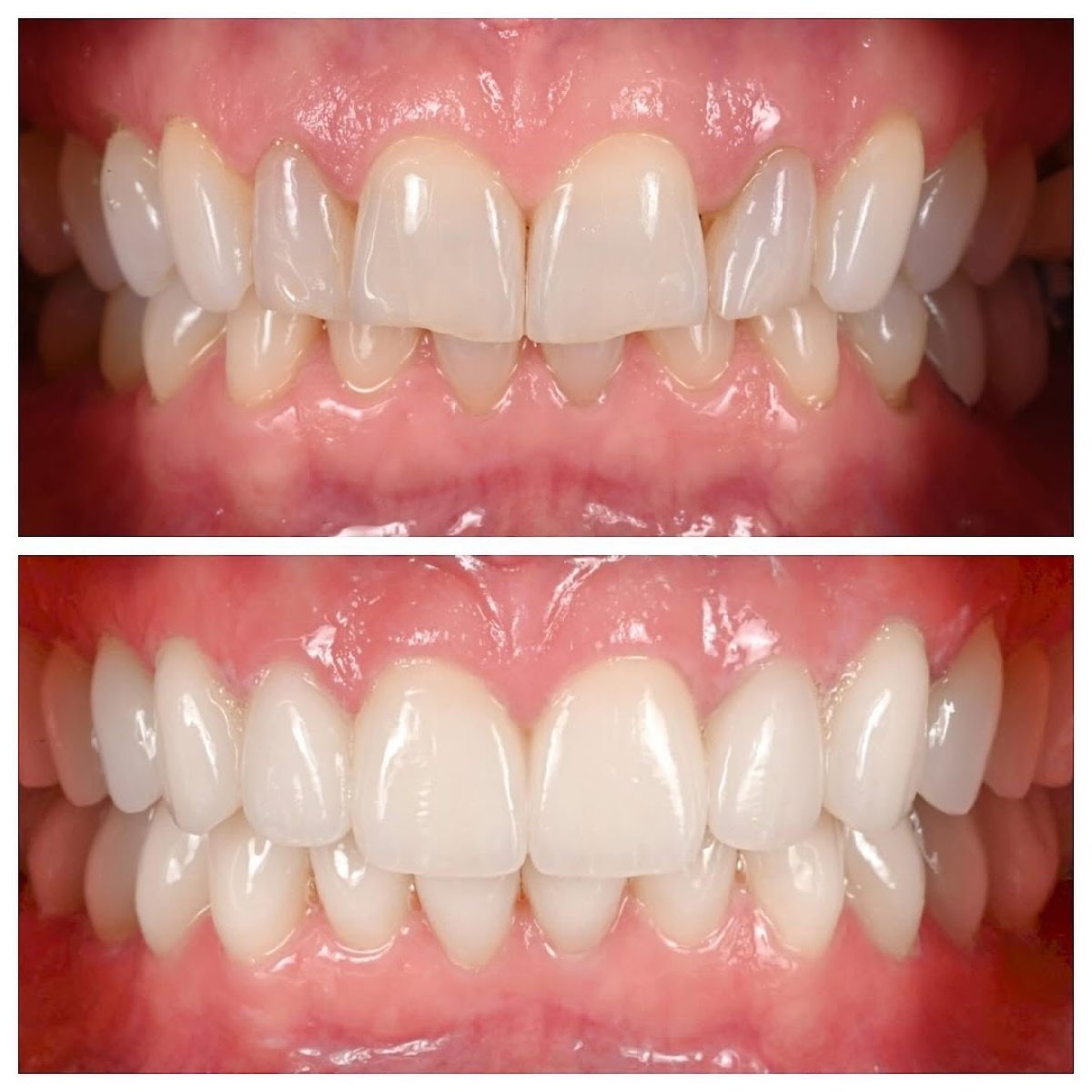 نتائج قبل وبعد تجميل الابتسامة – تحسين ترتيب وتبييض الأسنان