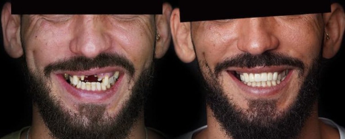 Resultados antes y después de smile makeover – restauración dental completa con carillas e implantes