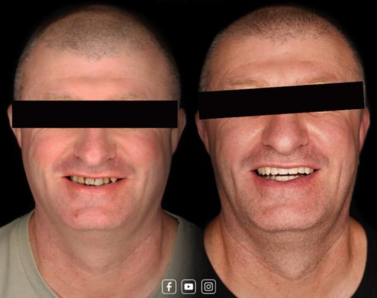 Resultados antes y después de smile makeover: dientes alineados y sonrisa más blanca