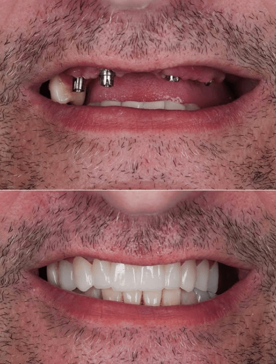 Before and after dental implant results – restored smile and teeth replacement