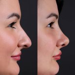 نتائج عملية تجميل الأنف قبل وبعد، إعادة تشكيل الأنف لمظهر طبيعي ومحسن