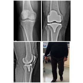 before-after photo robotic-knee-replacement-surgery