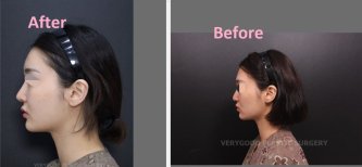 نتيجة تحديد الوجه بحقن الدهون قبل وبعد في عيادة VG Plastic Surgery