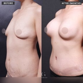 Przed i po powiększaniu piersi tłuszczem w VG Plastic Surgery, widoczny efekt