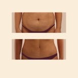 Résultats avant/après abdominoplastie et liposuccion à InSense Clinic (SV Plastic Surgery Clinic)