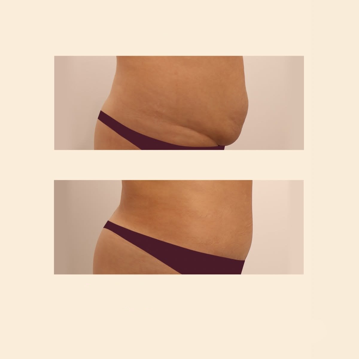 نتائج شد البطن والشفط قبل وبعد في InSense Clinic، بطن مسطح