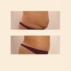 Résultats avant/après abdominoplastie et liposuccion à InSense Clinic, ventre plat
