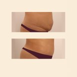 Résultats avant/après abdominoplastie et liposuccion à InSense Clinic, ventre plat