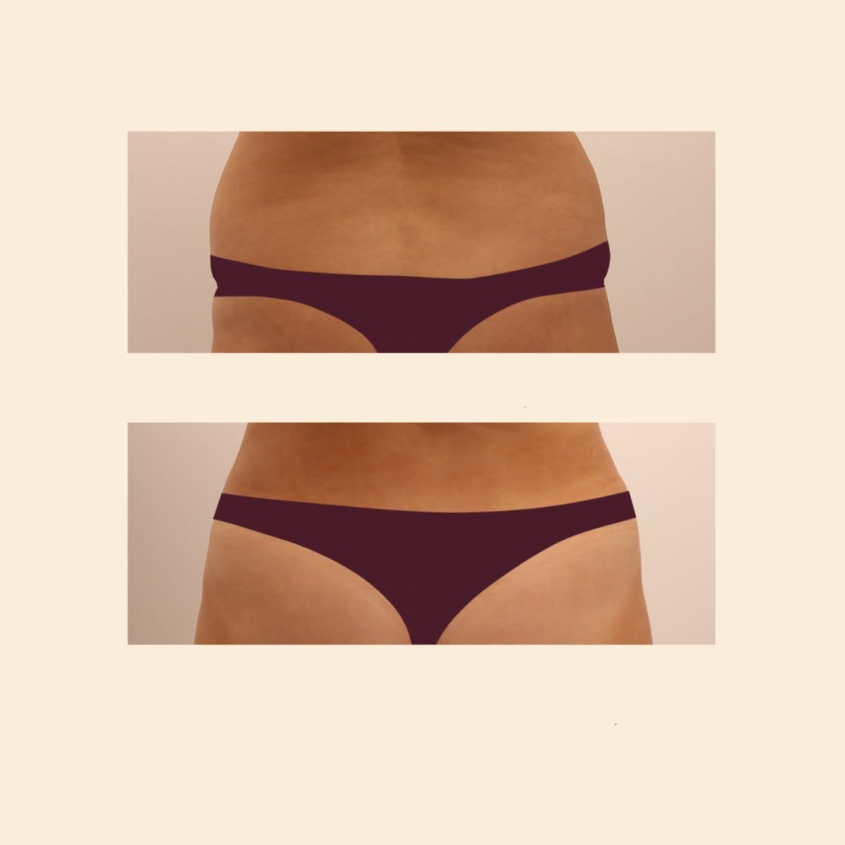 Resultados de liposucción antes y después en InSense Clinic, mejora visible de la cintura