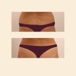 Before and after liposuction results at InSense Clinic, visible waist contour improvement