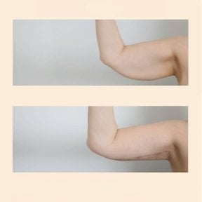 Before and after arm lift (brachioplasty) results at InSense Clinic (SV Plastic Surgery Clinic)