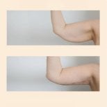 Before and after arm lift (brachioplasty) results at InSense Clinic (SV Plastic Surgery Clinic)