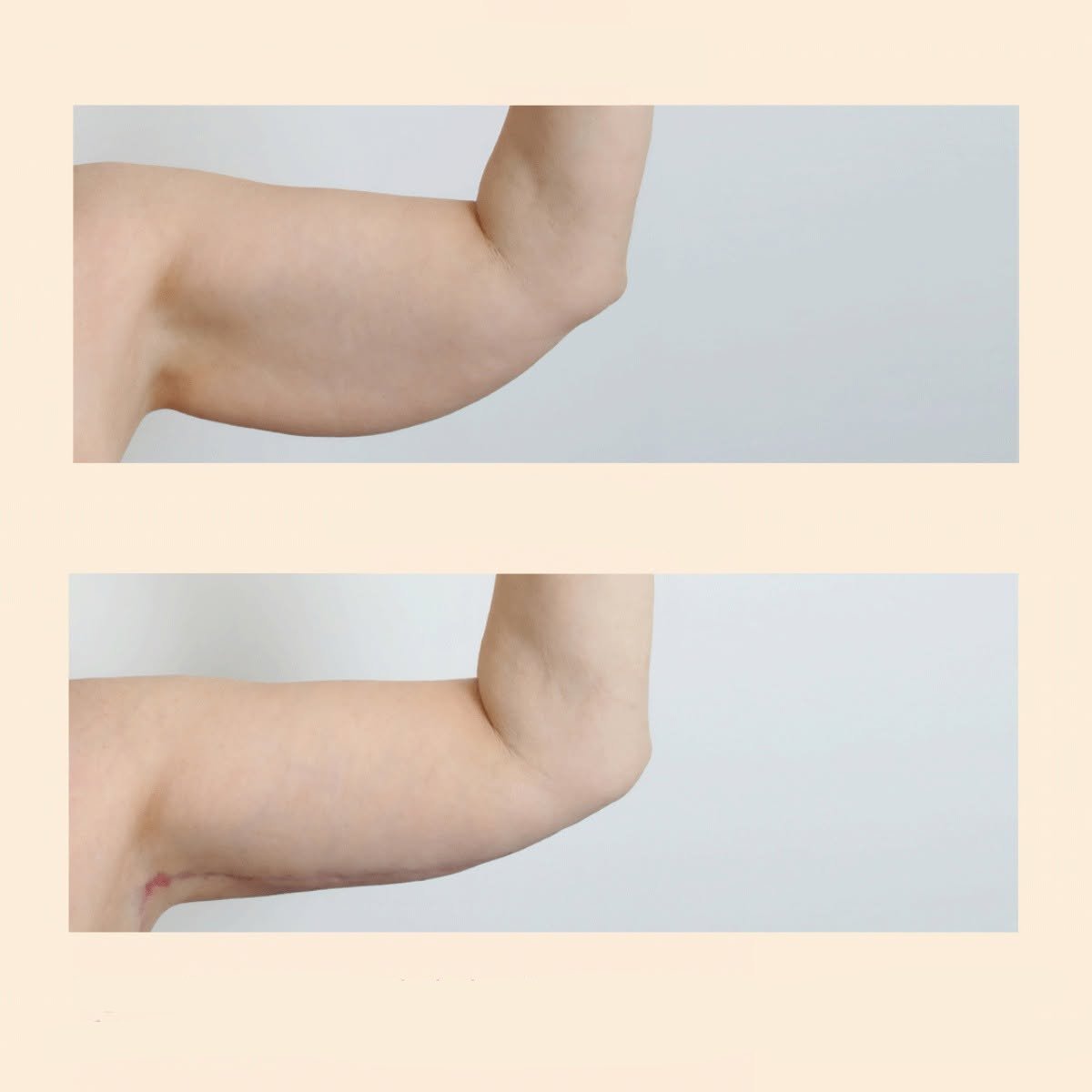 Resultados de lifting de brazos (braquioplastia) antes y después en InSense Clinic (SV Plastic Surgery Clinic)