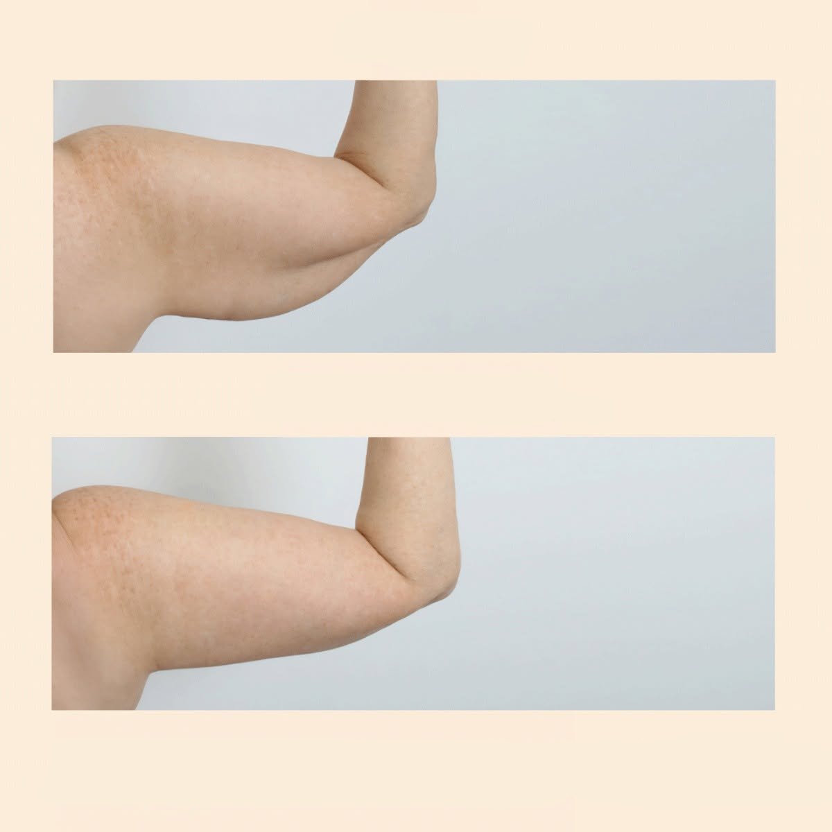 نتائج شد الذراعين (براكيوبلاستي) قبل وبعد في InSense Clinic (SV Plastic Surgery Clinic)