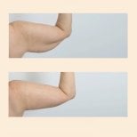 Before and after arm lift (brachioplasty) results at InSense Clinic (SV Plastic Surgery Clinic)