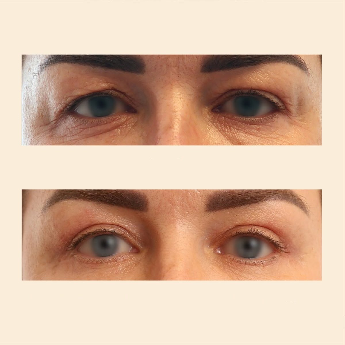 نتائج شد الجفون قبل وبعد في InSense Clinic، تصحيح الجفون لمظهر أكثر شبابًا
