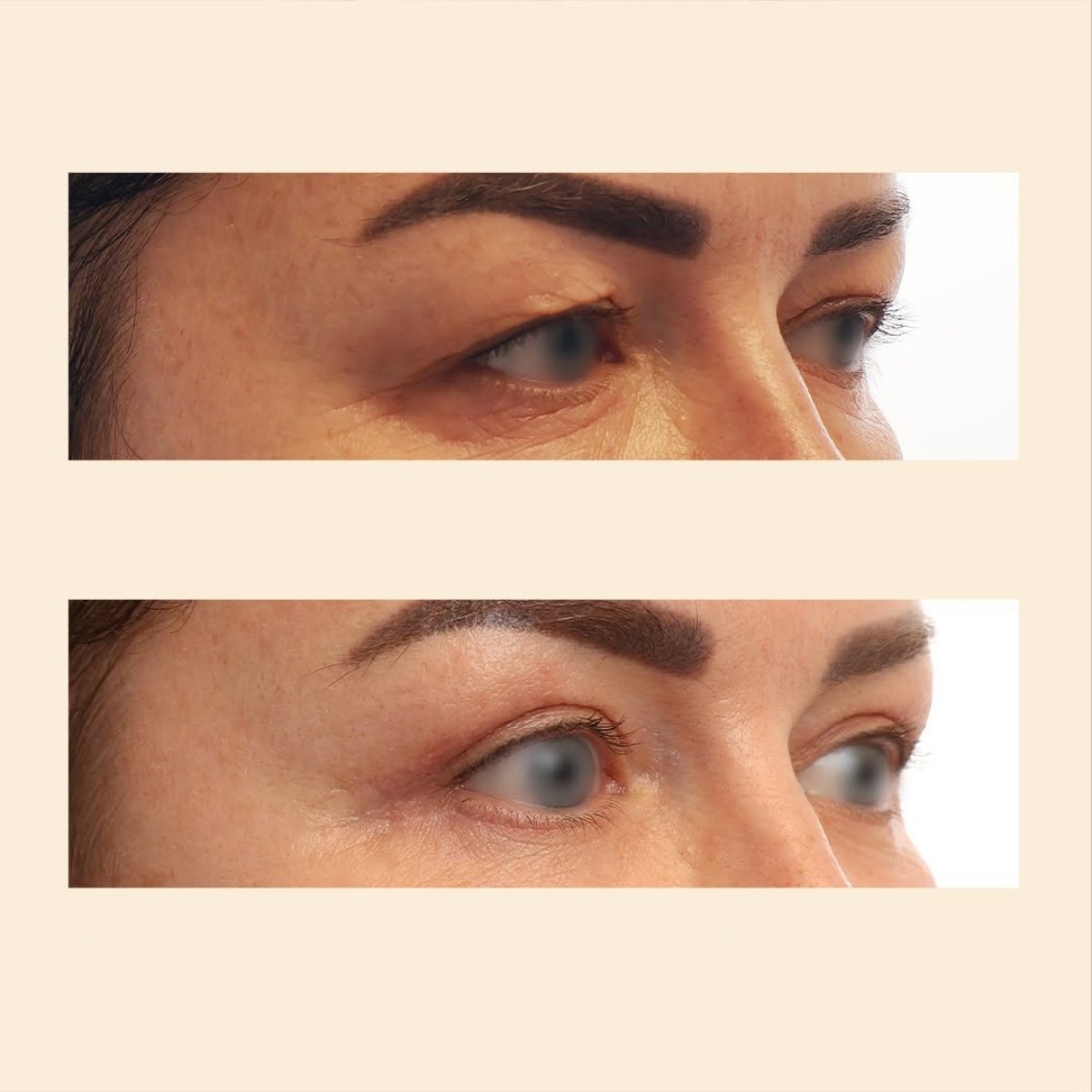 نتائج قبل وبعد جراحة تجميل الجفون في InSense Clinic (SV Plastic Surgery Clinic)، رفع الجفن