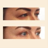 Before and after blepharoplasty results at InSense Clinic (SV Plastic Surgery Clinic), eyelid lift