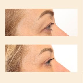 Before and after blepharoplasty results at InSense Clinic (SV Plastic Surgery Clinic), eyelid lift