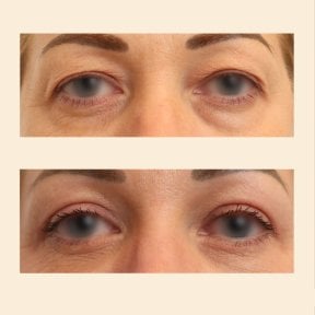 Before and after blepharoplasty results at InSense Clinic, eyelid correction for youthful eyes