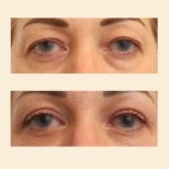 Before and after blepharoplasty results at InSense Clinic, eyelid correction for youthful eyes