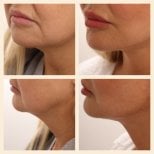 Facelift before and after results at InSense Clinic (SV Plastic Surgery Clinic), jawline rejuvenation