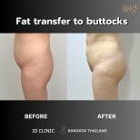 نتائج نقل الدهون للأرداف قبل وبعد في ID Clinic Bangkok وتحسن واضح في الشكل